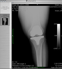 image of knee replacement illustrating article on lack of benefit of glucosamine